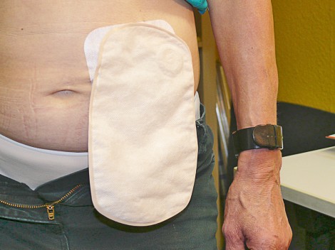 Dieses Foto zeigt einen Patient mit einem Stomabeutel am Bauch.